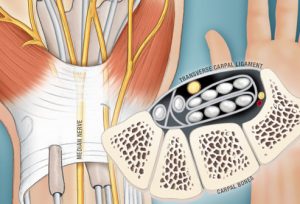 carpal tunnel photo