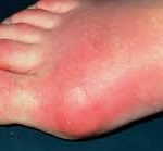gout