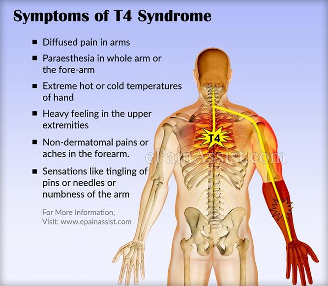 T4 Syndrome 