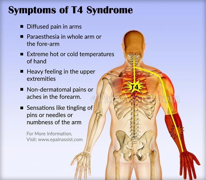 Bilateral Arm Pain Numbness That Wont Go Away T4 Syndrome Is More 