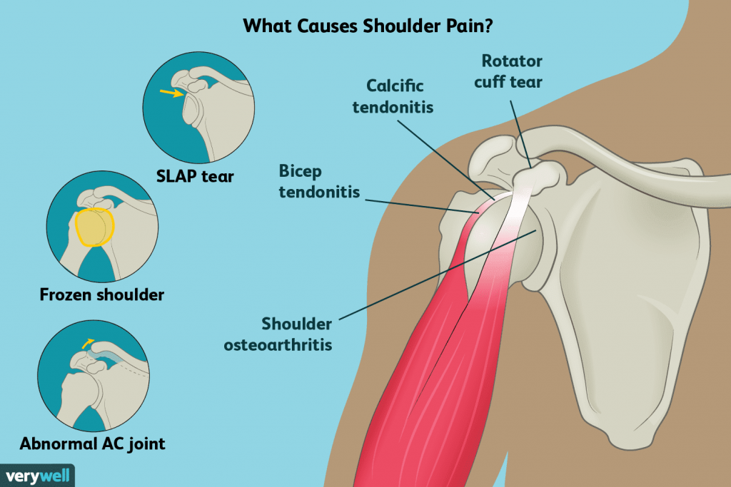 LONG NERVE THORACIC PALSY - City Osteopathy